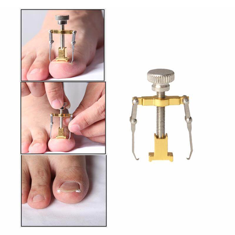 Ingrown Toe Nail Removal Bunion Corrector Pain Relief Foot Care Tool