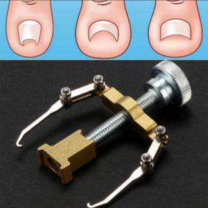 Ingrown Toe Nail Removal Bunion Corrector Pain Relief Foot Care Tool