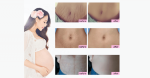 Pregnancy Scars And Stretch Mark Removal Cream