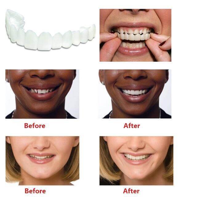 Snap On Veneers Instant Perfect Smile Comfortable Upper Teeth Cover